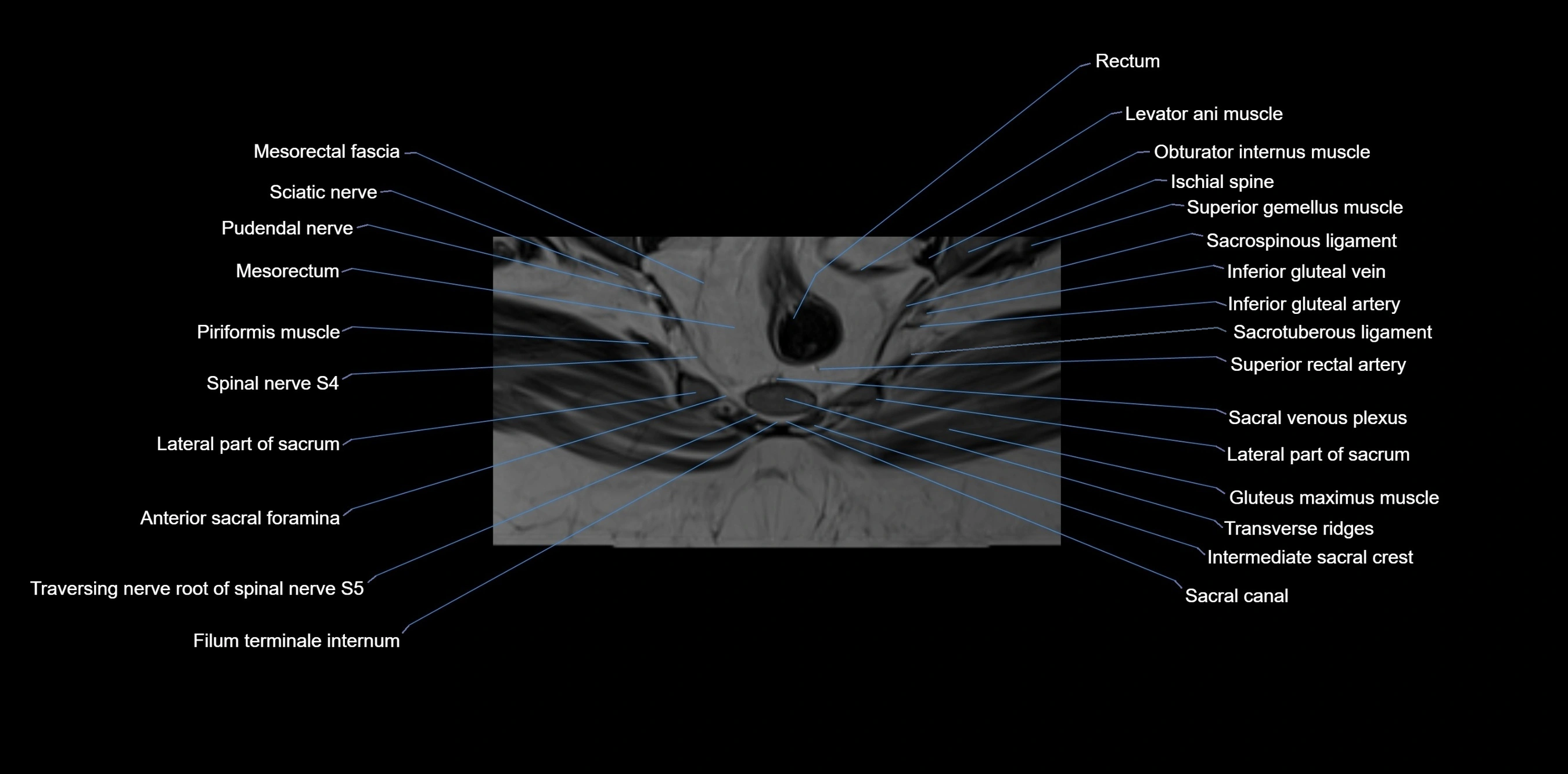 MRI sacrum, coccyx and sacroiliac joint axial cross sectional anatomy 3T  radiology  image-img-00001-00054.webp